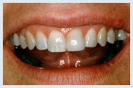 Bonding - Case 1 After