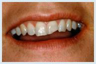 Bonding - Case 1 Before