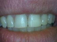 Bonding - Case 2 After