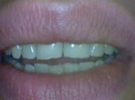 Bonding - Case 2 Before