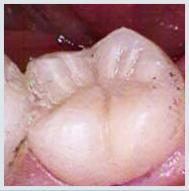 Composite Fillings - Case 1 After