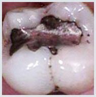 Composite Fillings - Case 1 Before