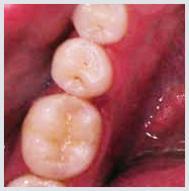 Composite Fillings - Case 2 After
