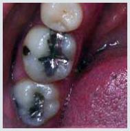 Composite Fillings - Case 2 Before