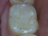 Composite Fillings - Case 3 After