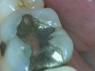 Composite Fillings - Case 3 Before