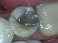 Composite Fillings - Case 4 Before