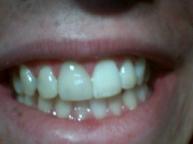 Crowns - Case 2 After