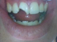 Crowns - Case 2 Before