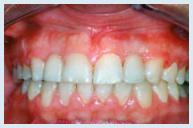 Dental Implant - Case 1 After