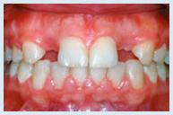 Dental Implant - Case 1 Before