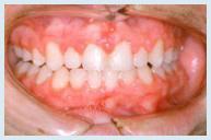 Orthodontics - Case 1 After