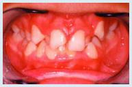Orthodontics - Case 1 Before