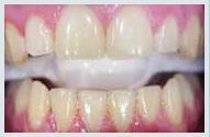 Teeth Whitening - Case 1 Before