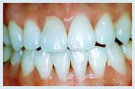 Teeth Whitening - Case 2 After