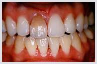 Teeth Whitening - Case 2 Before