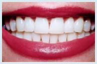 Teeth Whitening - Case 3 After