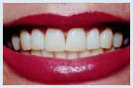 Teeth Whitening - Case 3 Before
