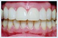Veneers - Case 1 After