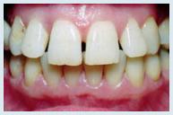 Veneers - Case 1 Before